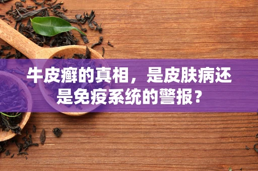 牛皮癣的真相，是皮肤病还是免疫系统的警报？